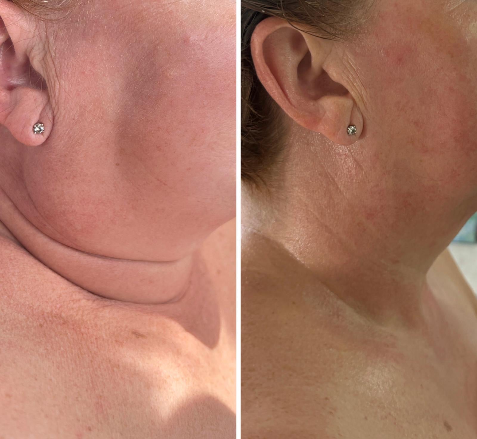 Radio Frequency Microneedling Face