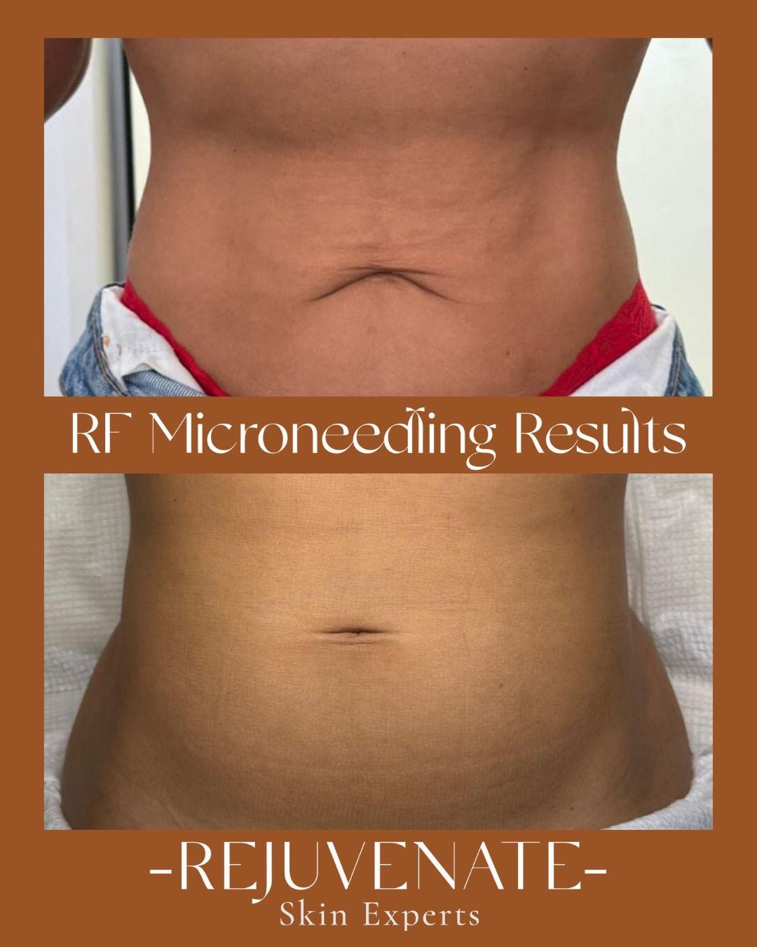 Radio Frequency Microneedling Body