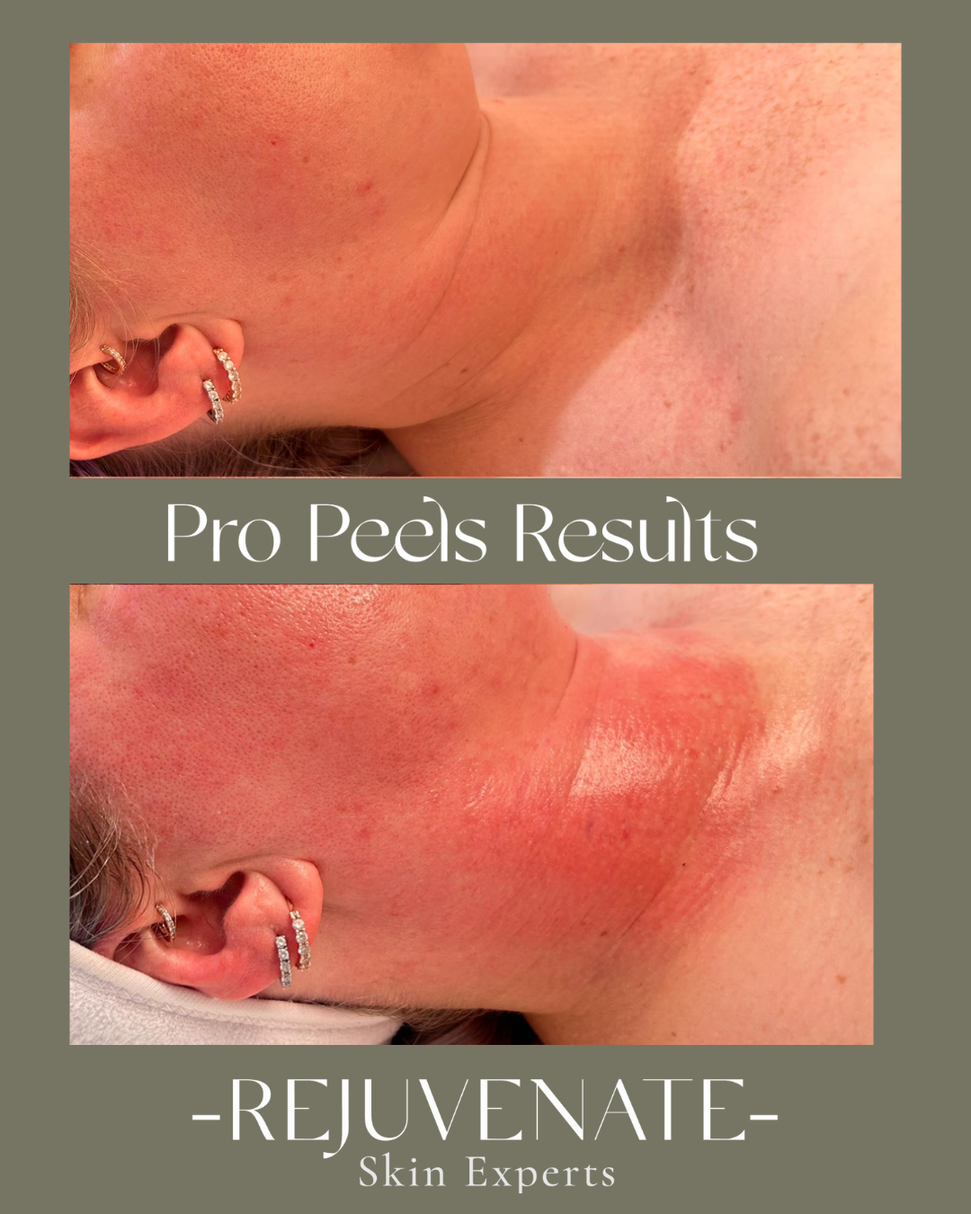 Pro Peel