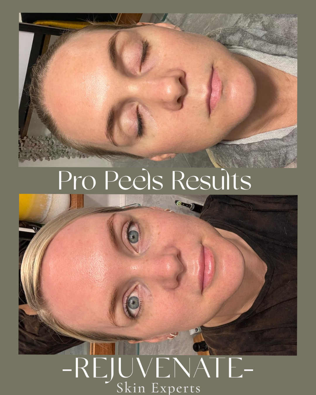 Pro Peel