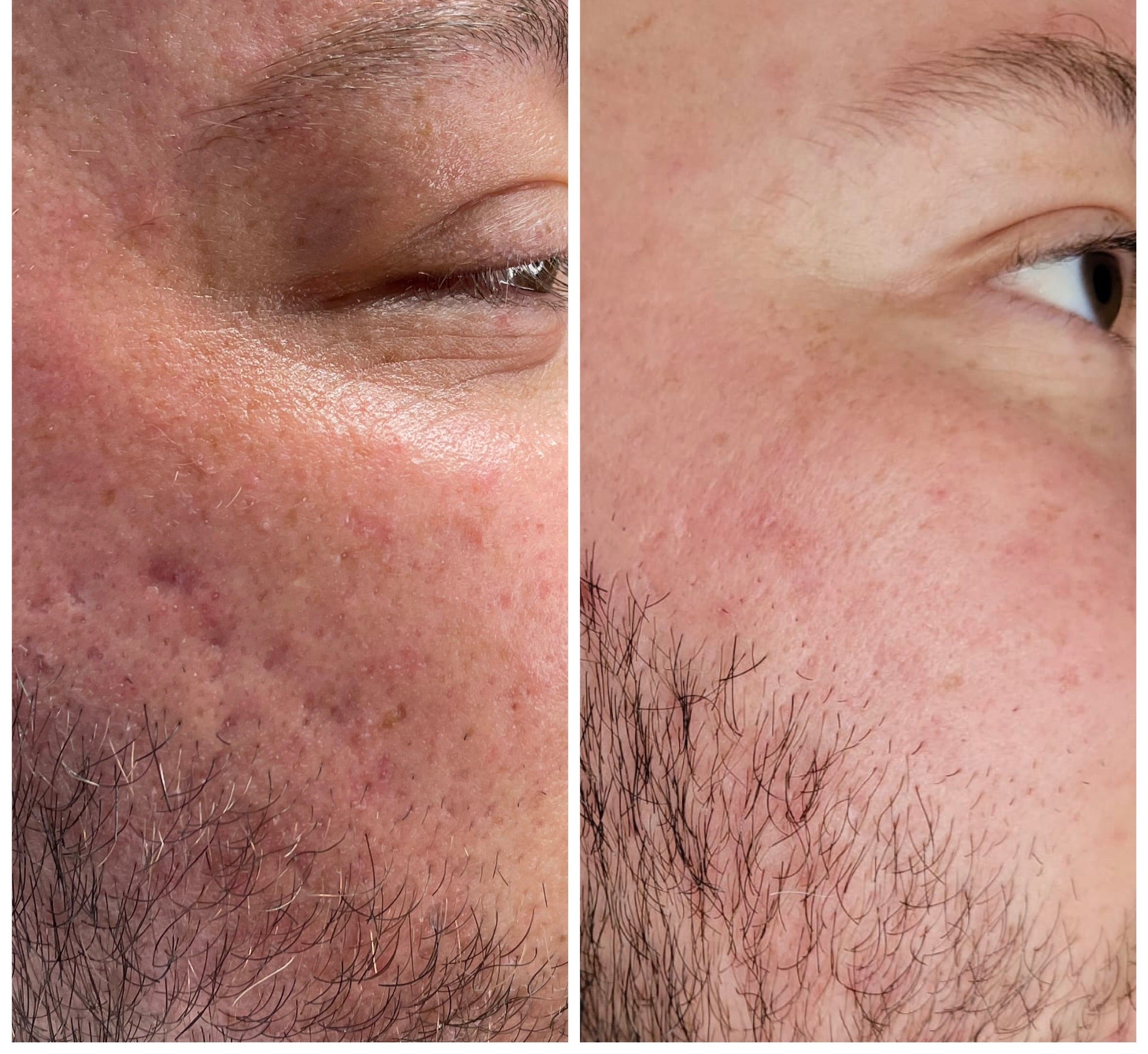 Microneedling Facial