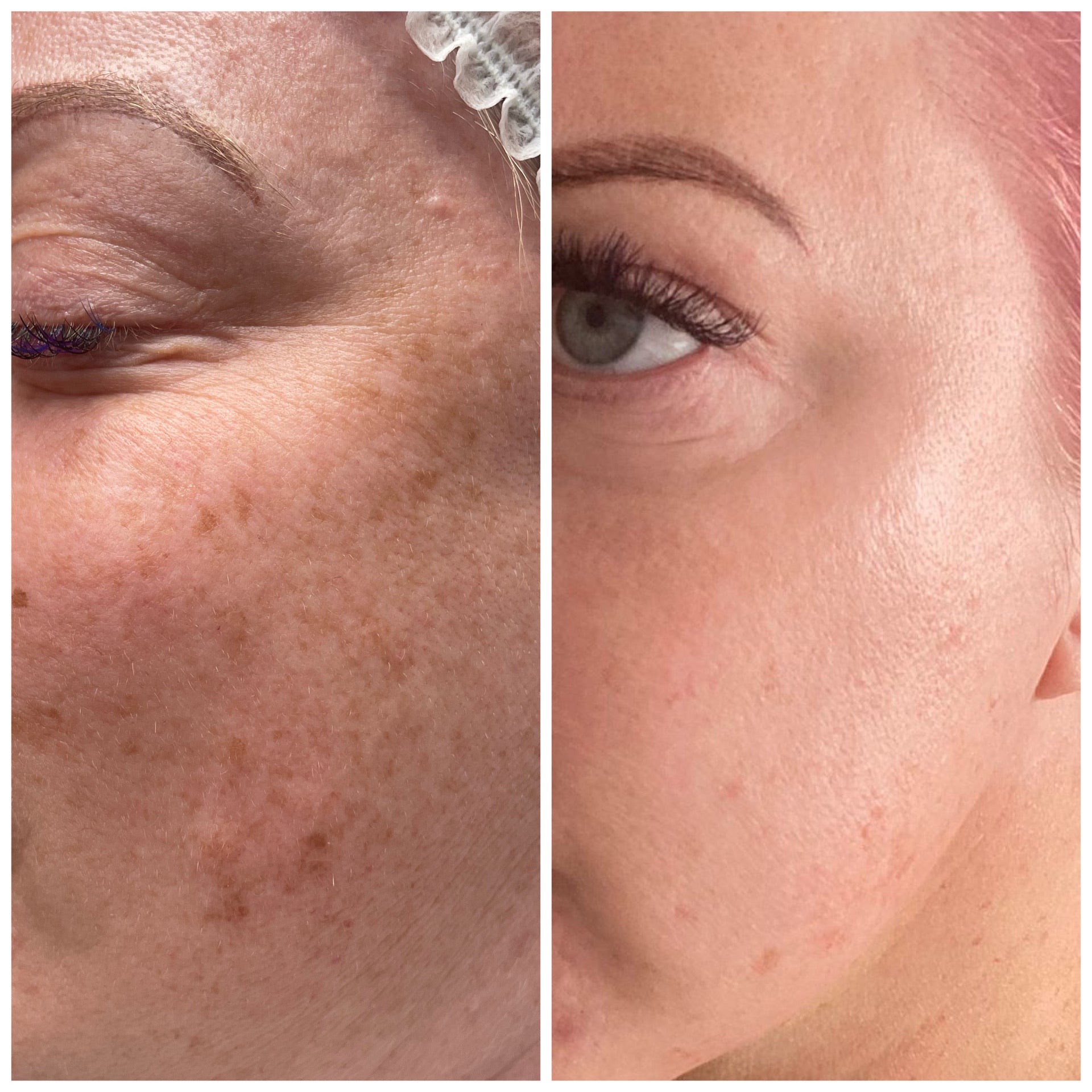 Microneedling Facial with Exosomes