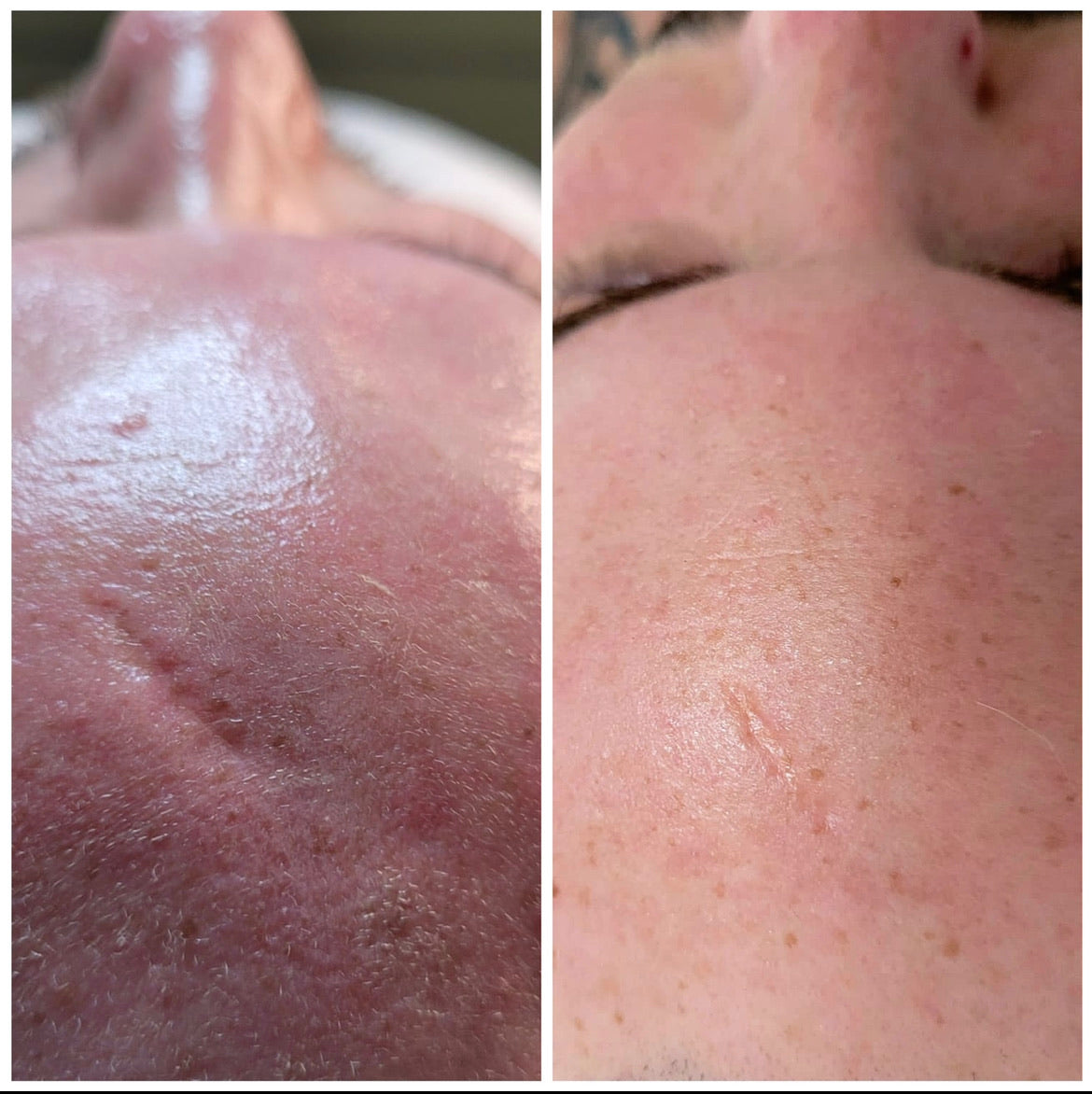 Microneedling Facial