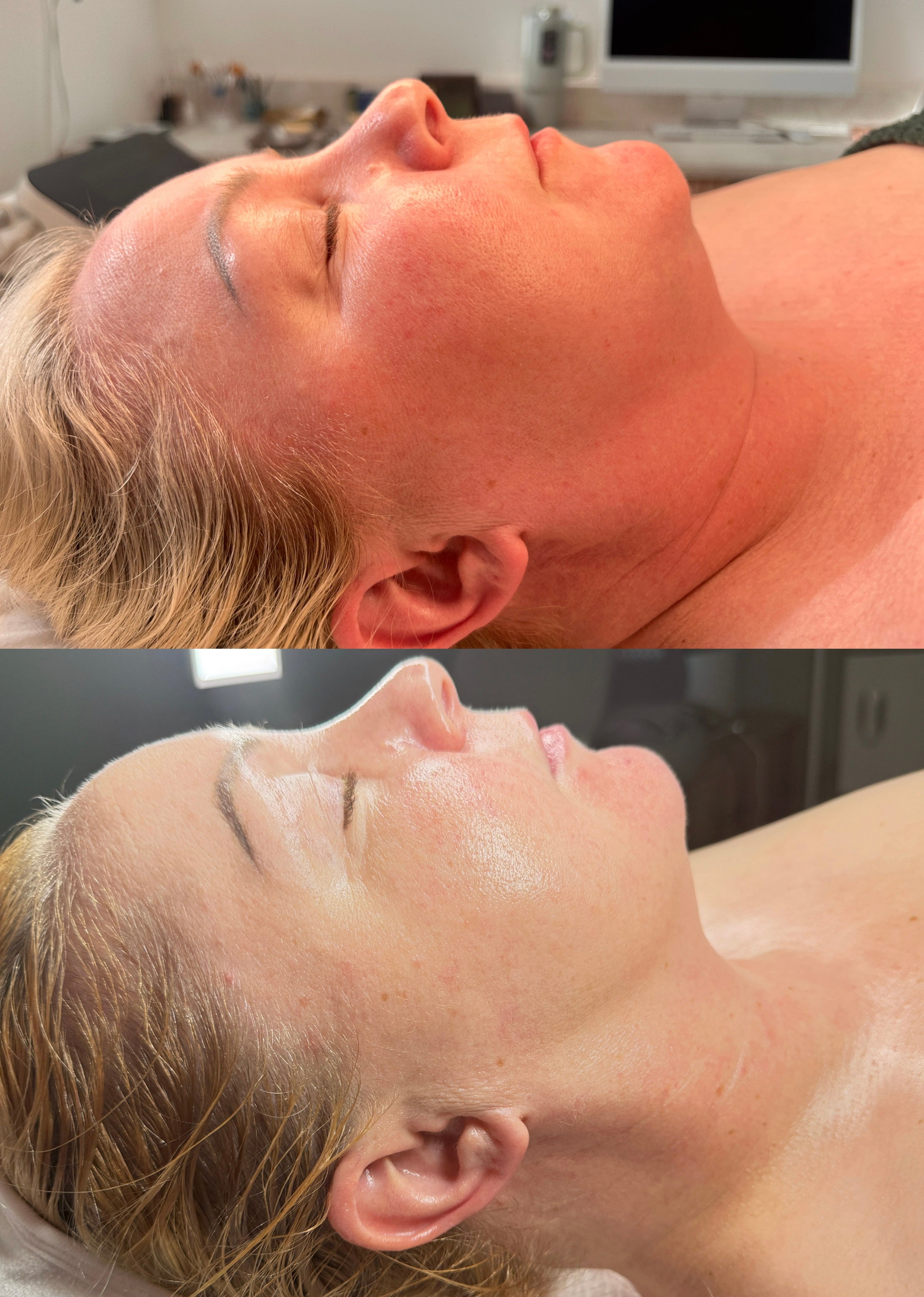 Radio Frequency Microneedling Face
