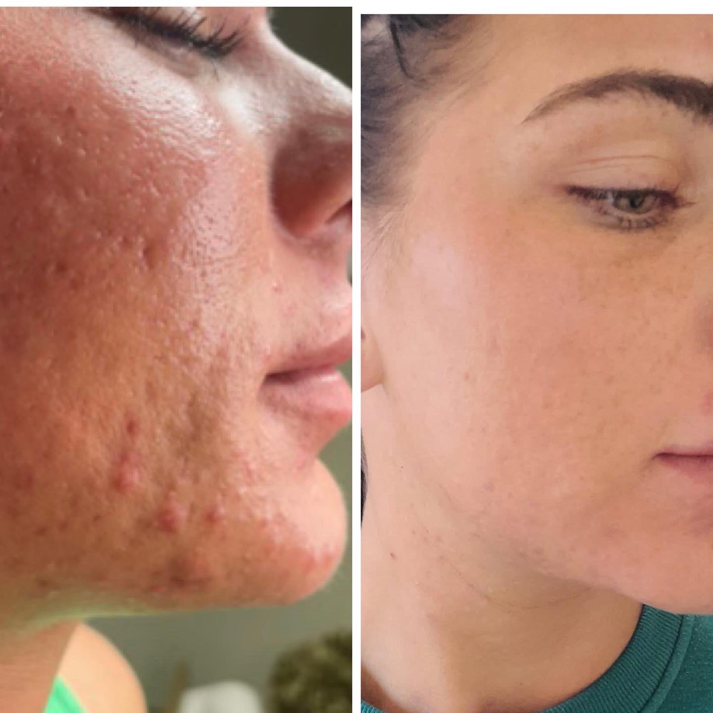 Microneedling Facial with Exosomes
