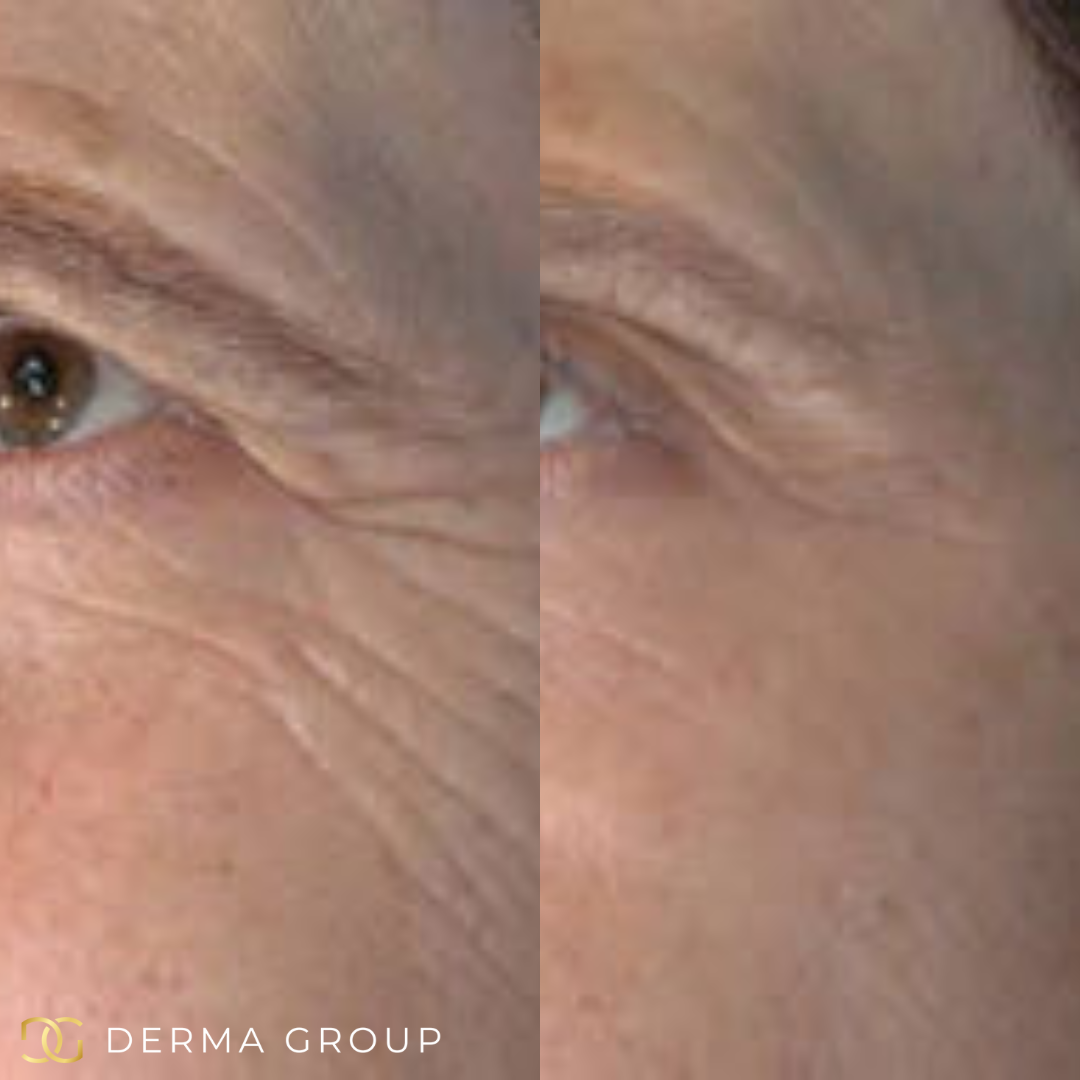 Radio Frequency Microneedling Face