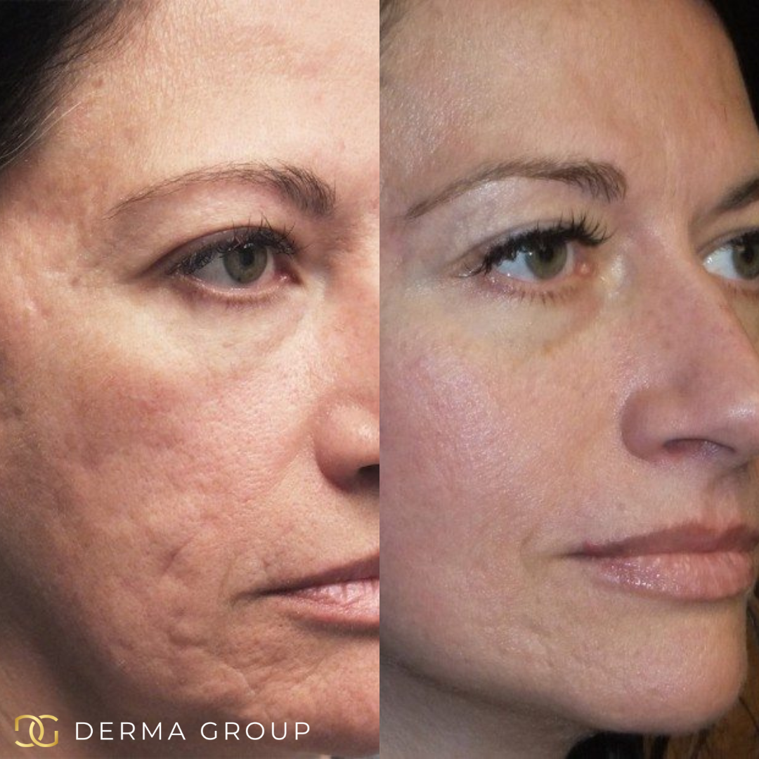 Radio Frequency Microneedling Face