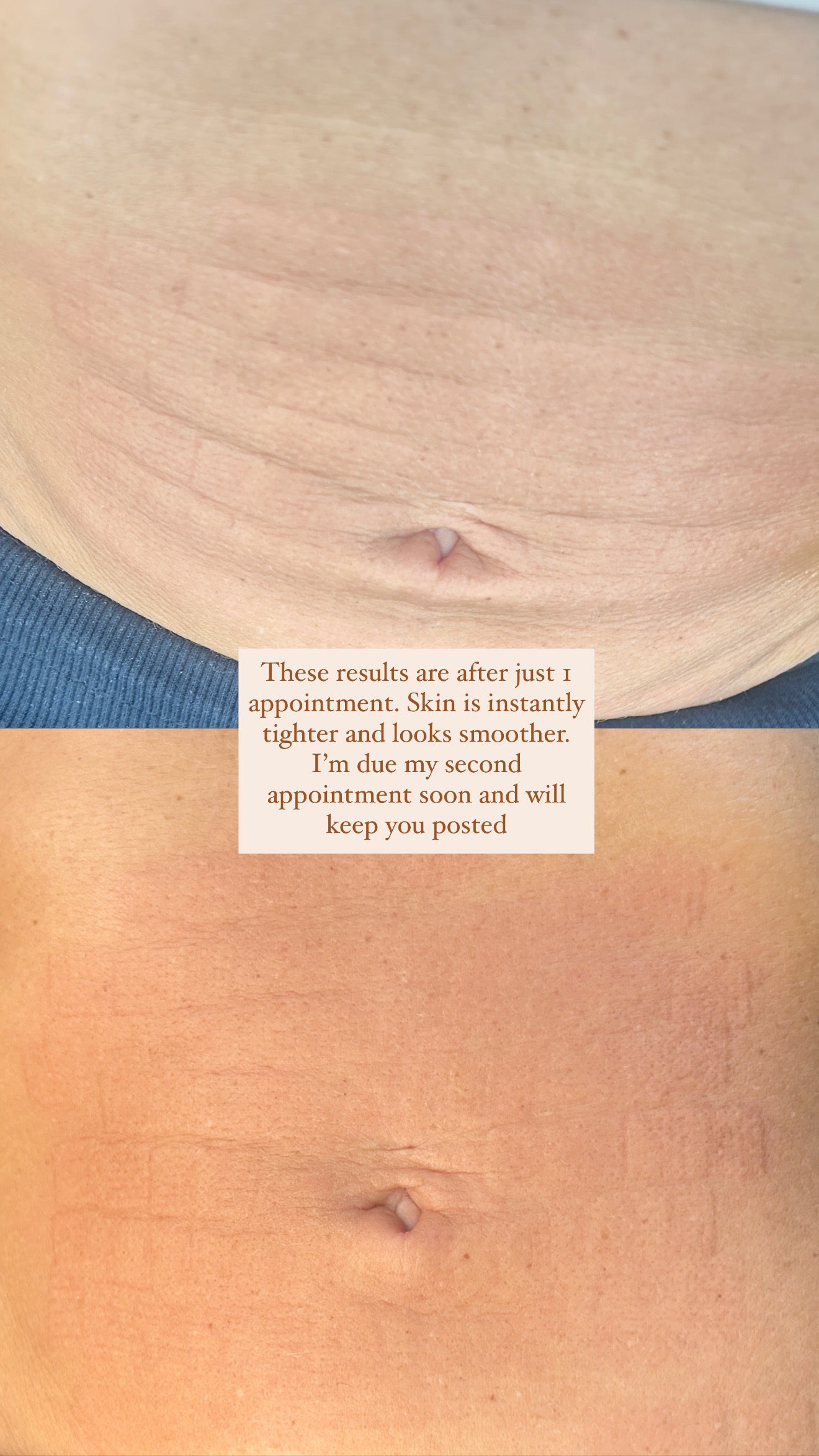 Radio Frequency Microneedling Body