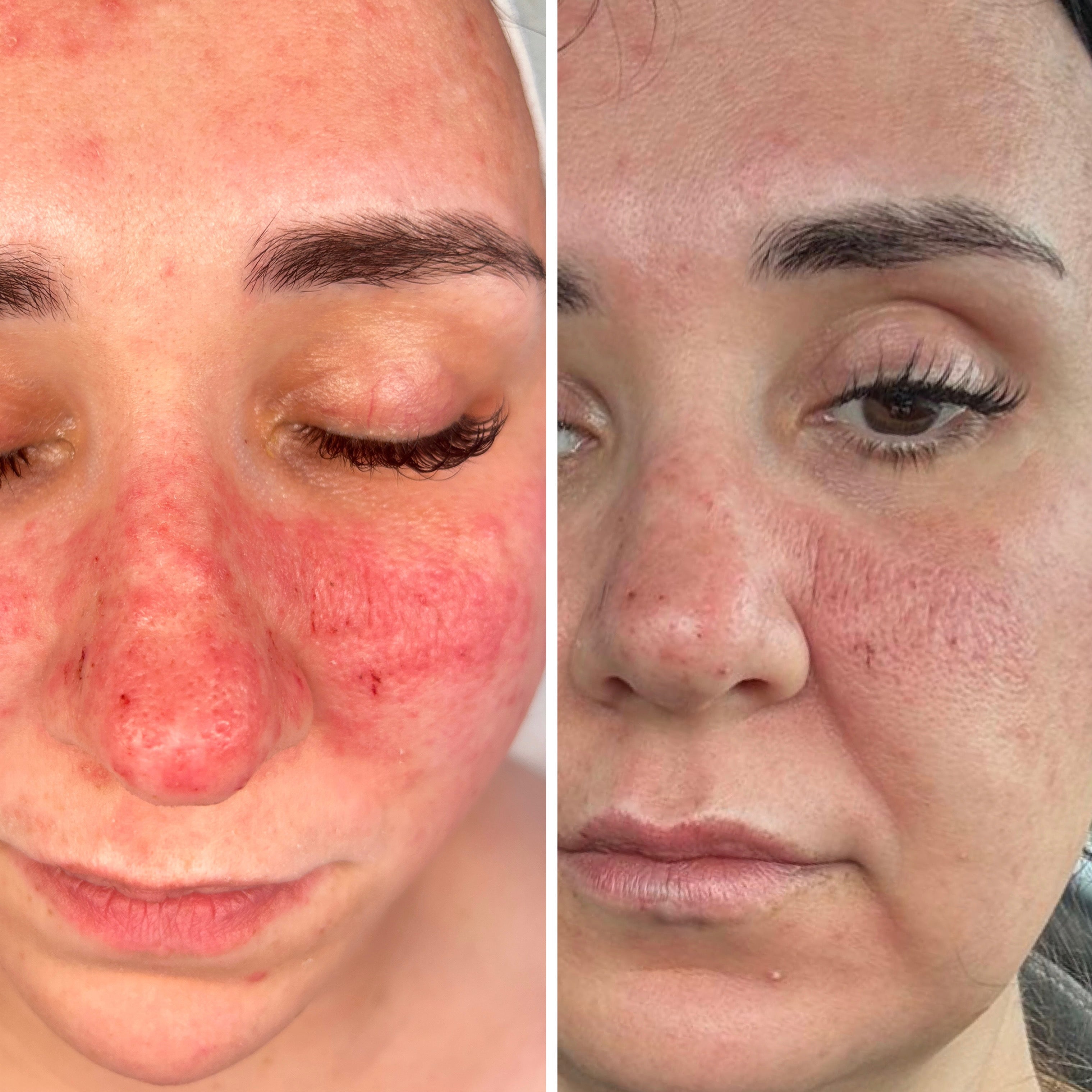 Microneedling Facial with Exosomes