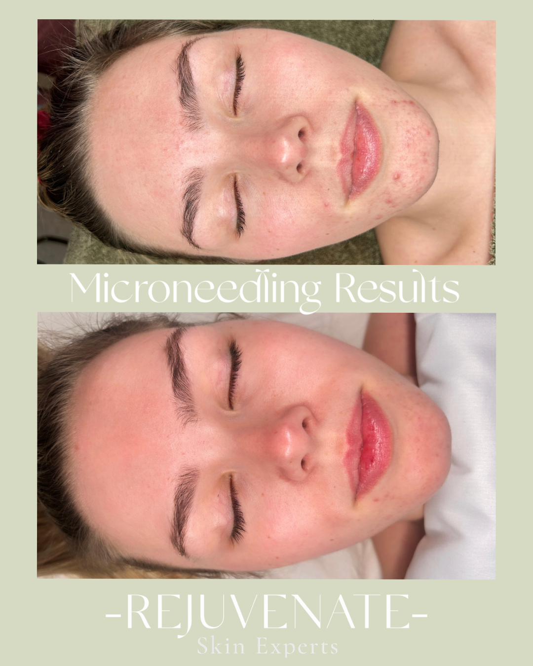Microneedling Master Class