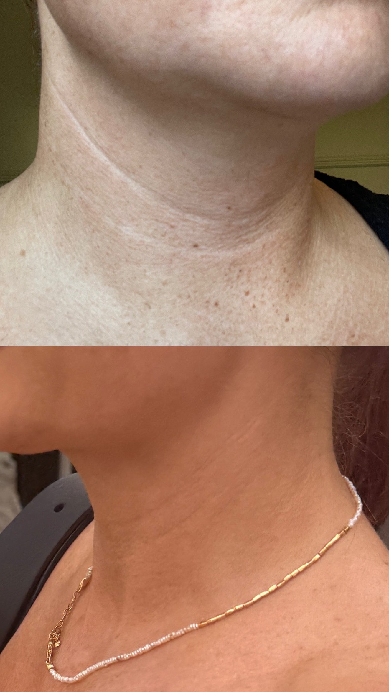Radio Frequency Microneedling Face