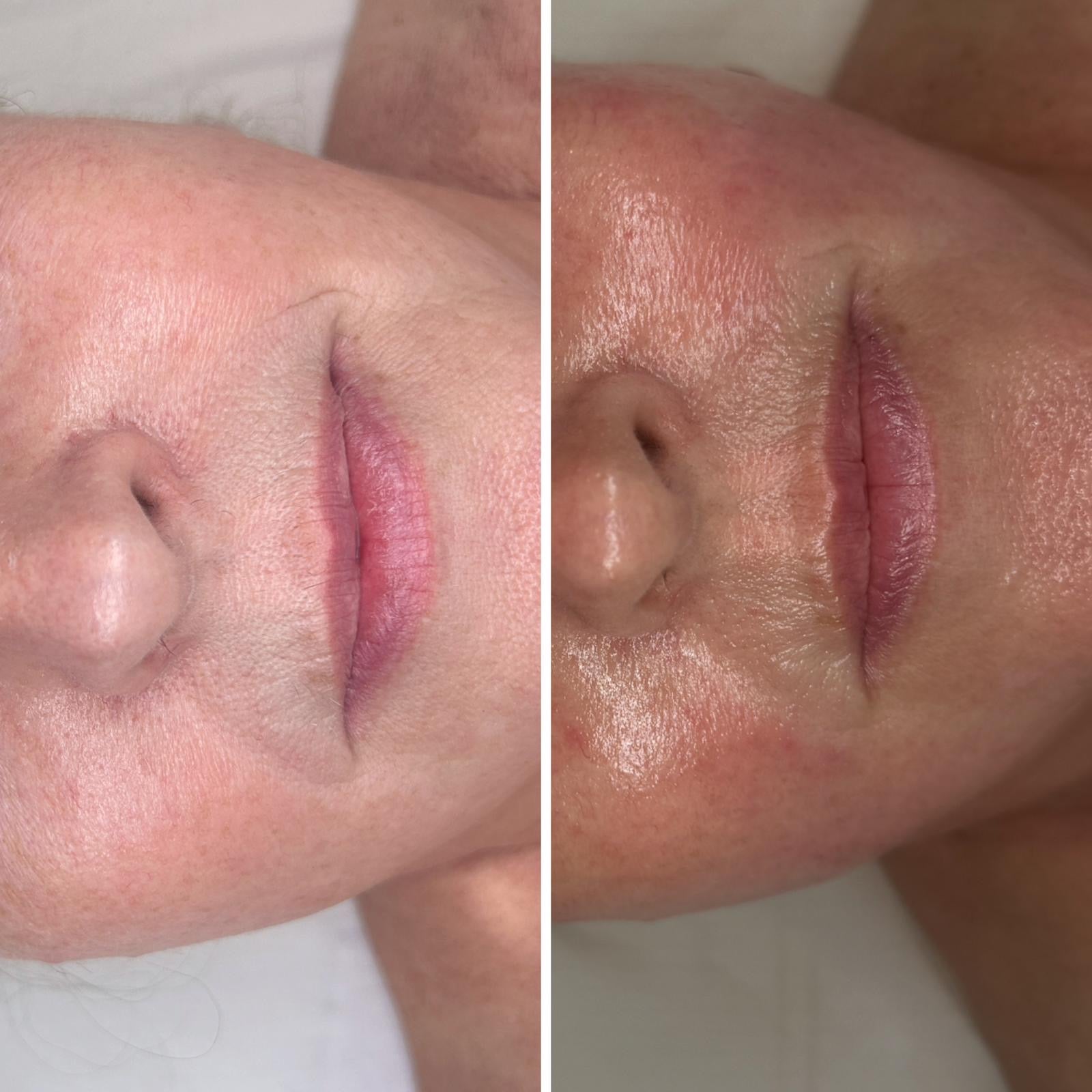 Radio Frequency Microneedling Face