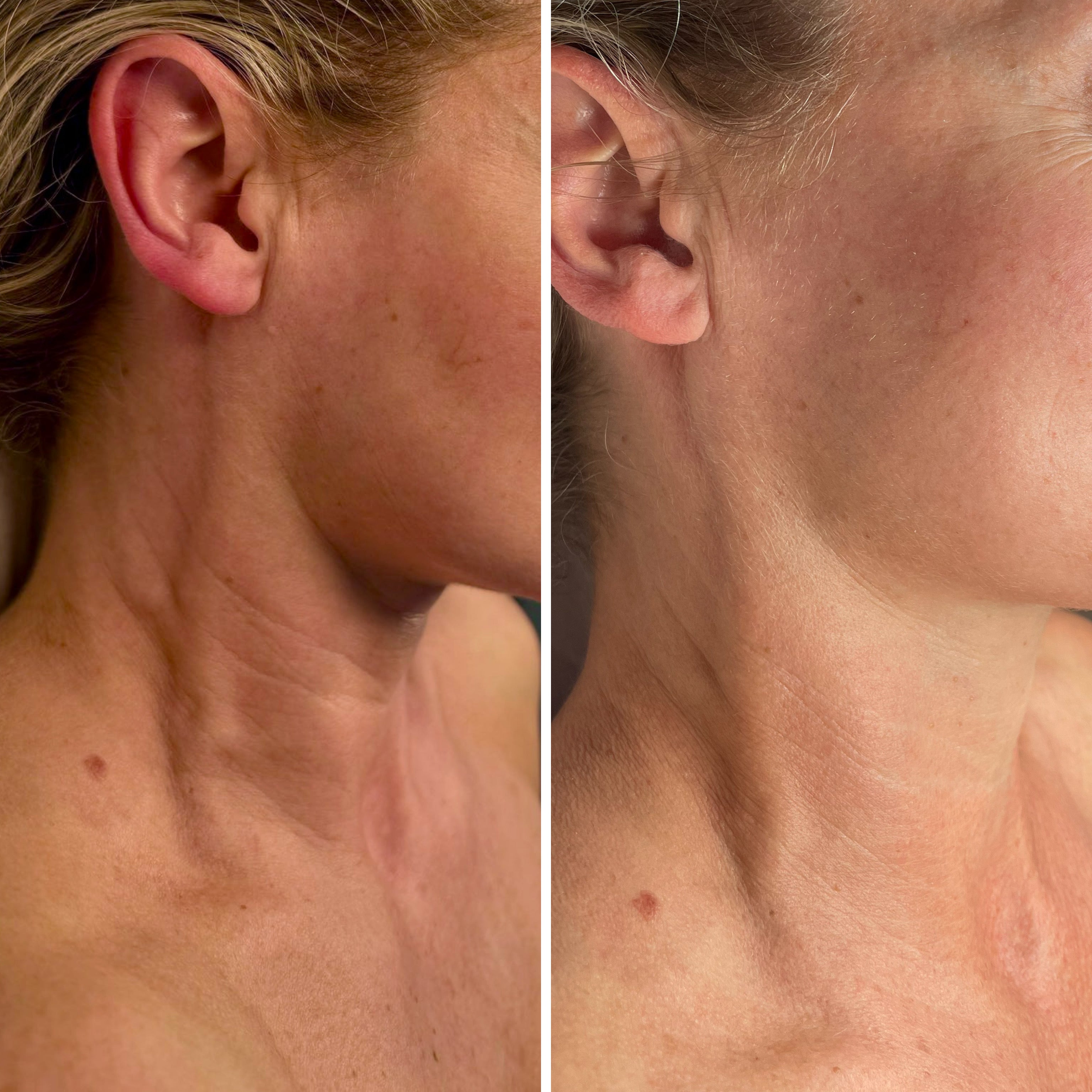 Radio Frequency Microneedling Face
