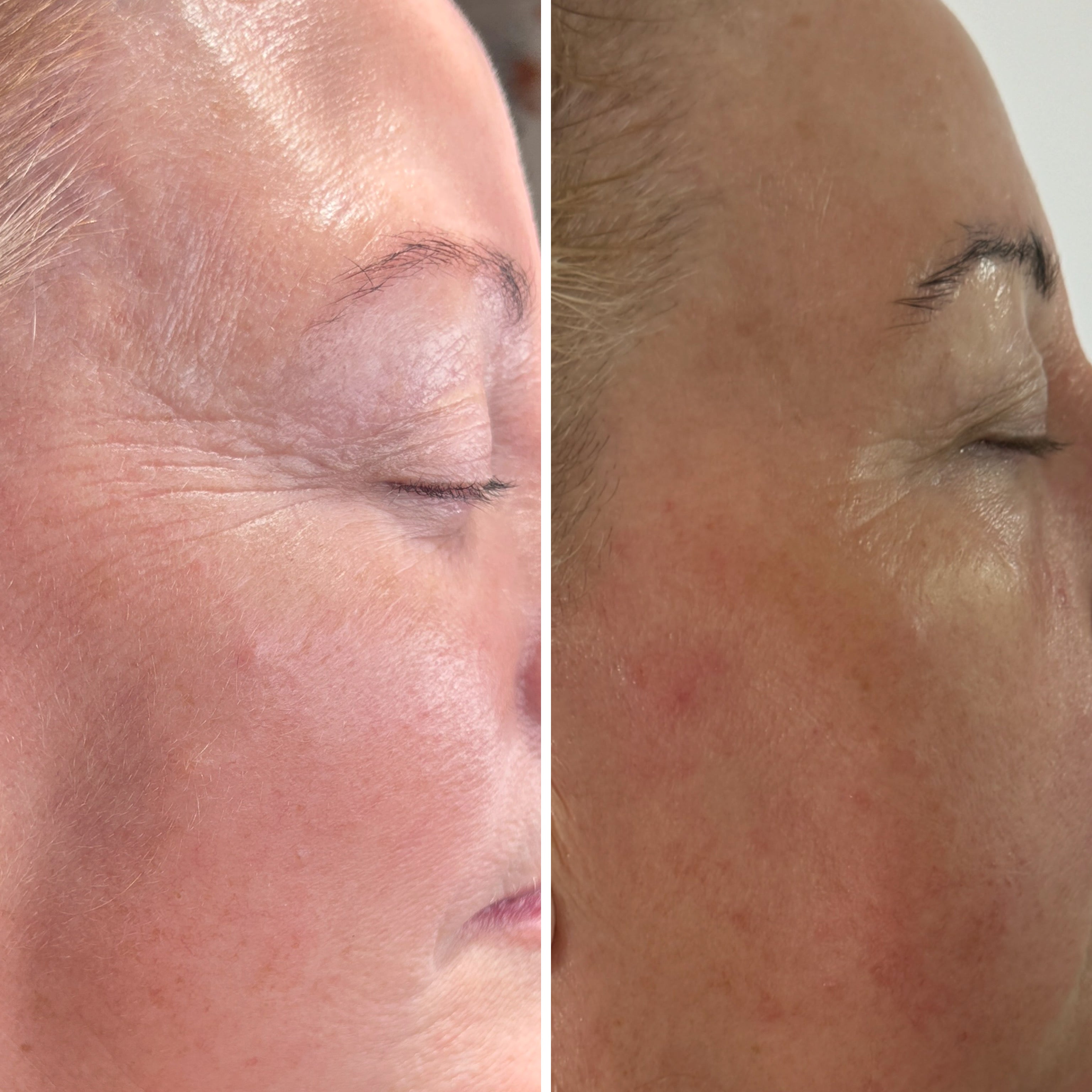 RF Microneedling Face Course
