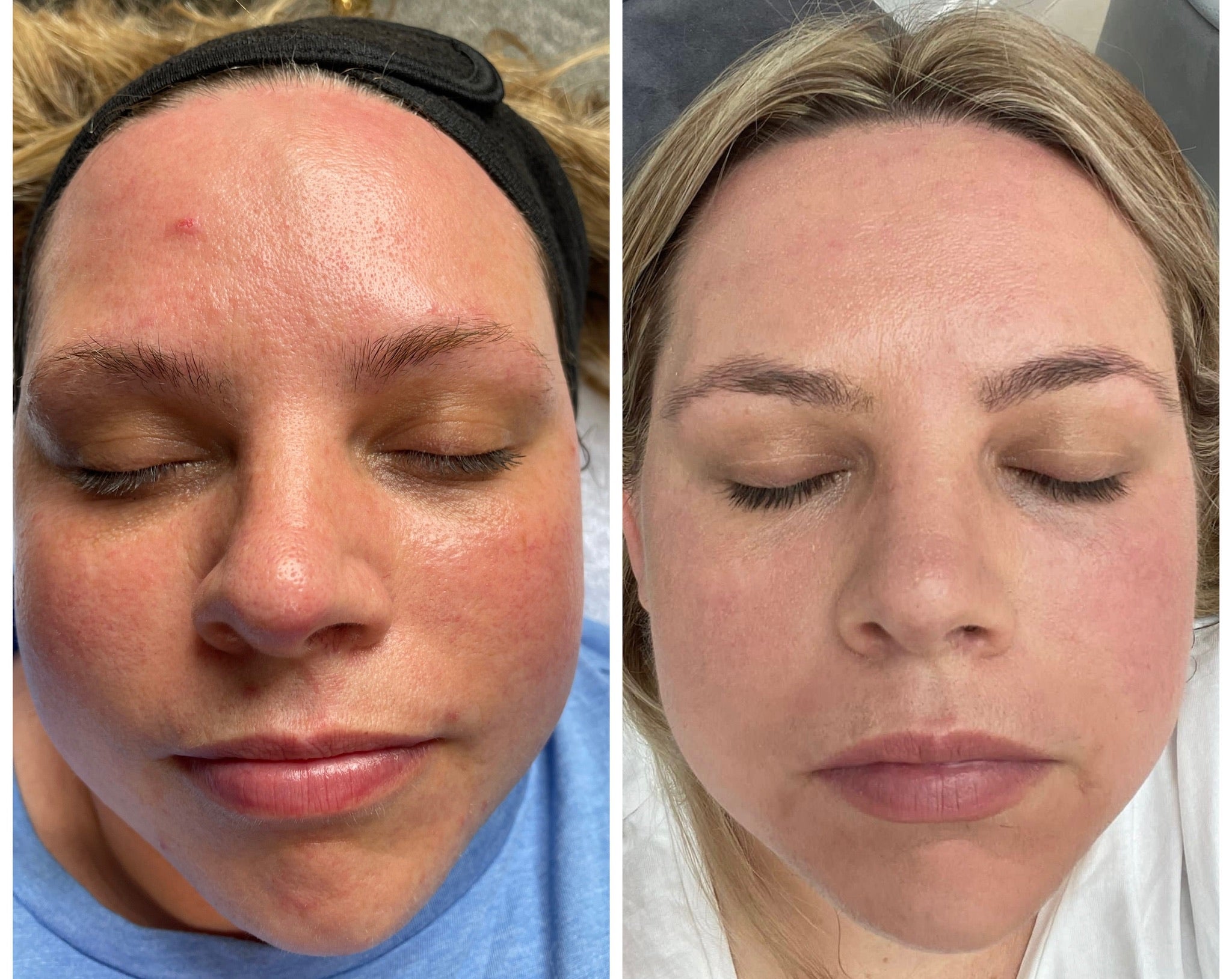 Microneedling Facial with Exosomes