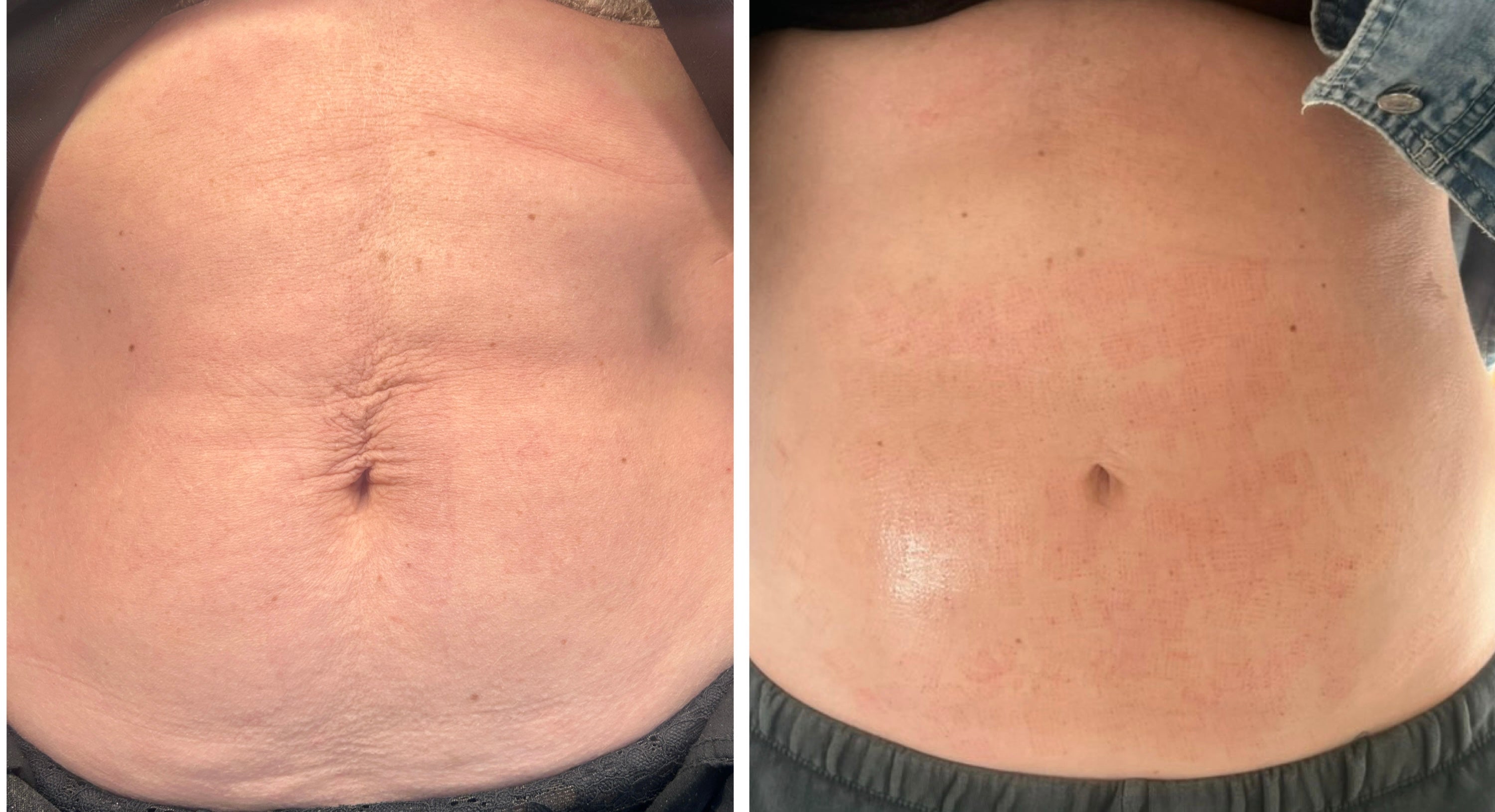 Radio Frequency Microneedling Body