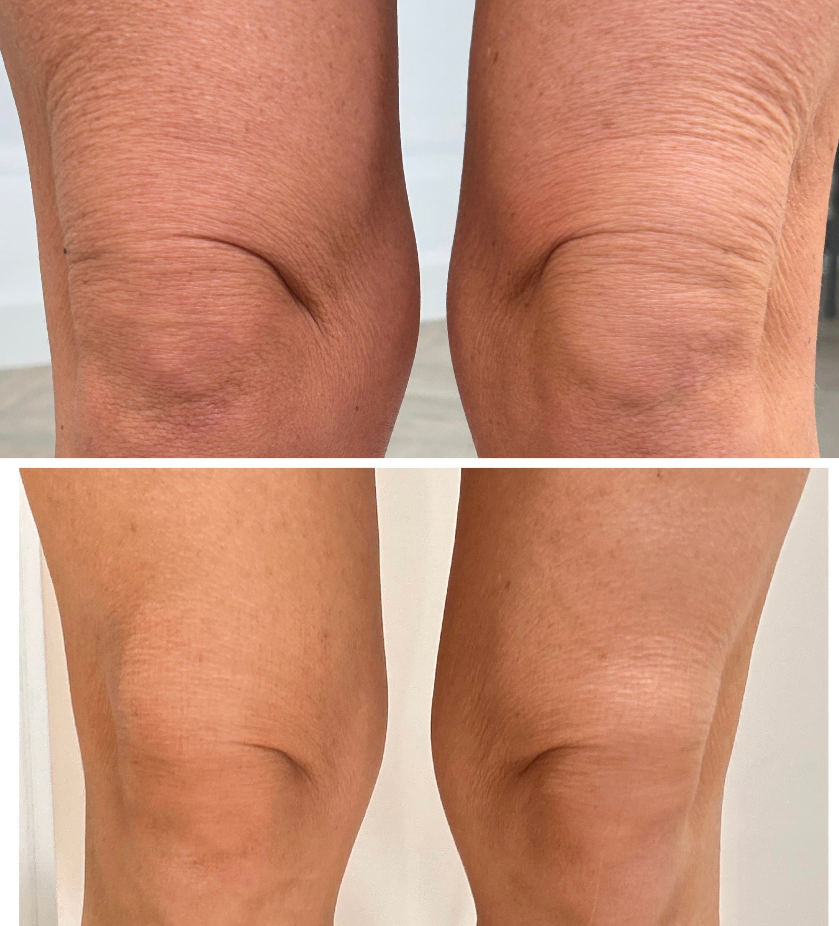 Radio Frequency Microneedling Body
