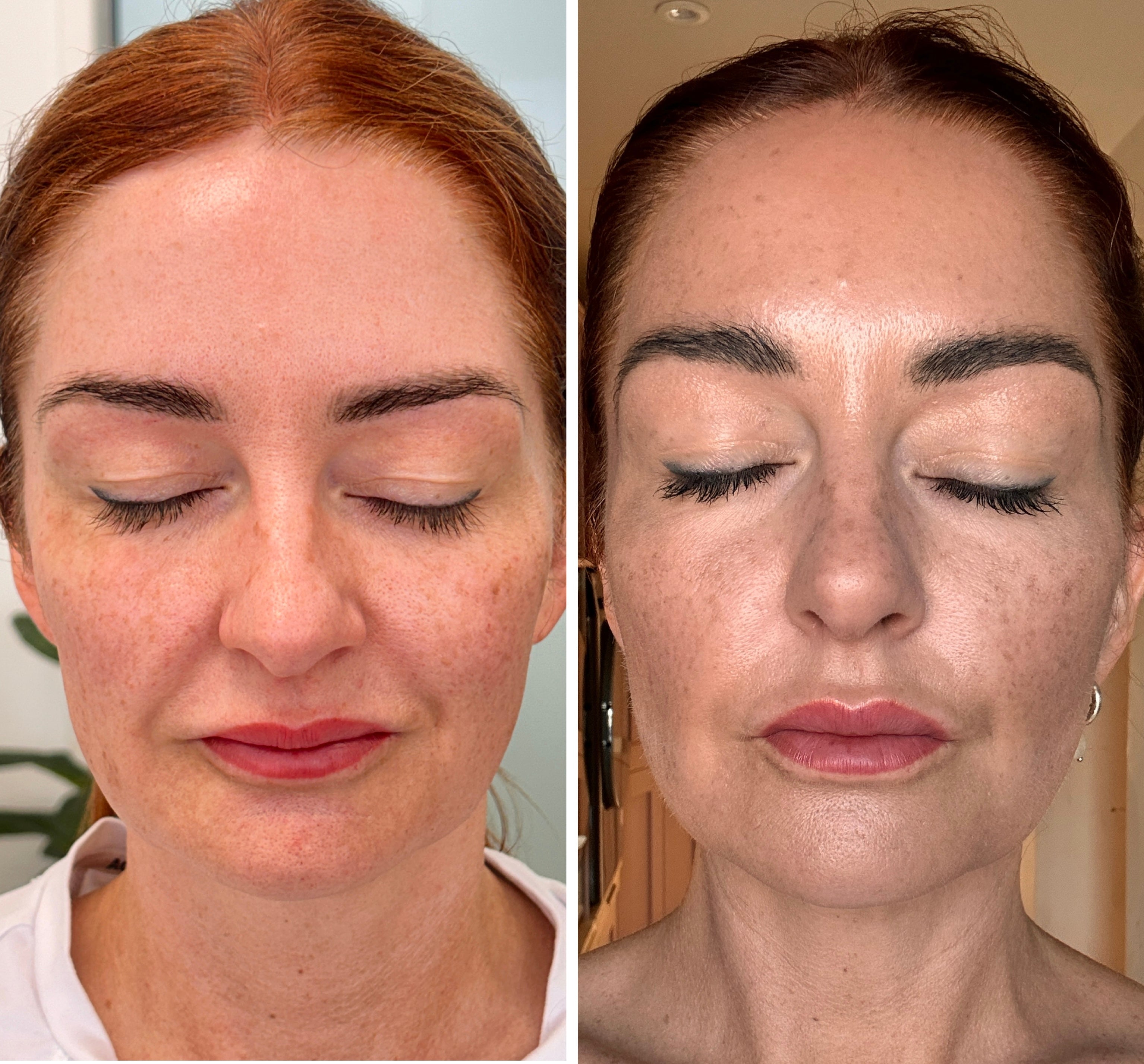 Radio Frequency Microneedling Face