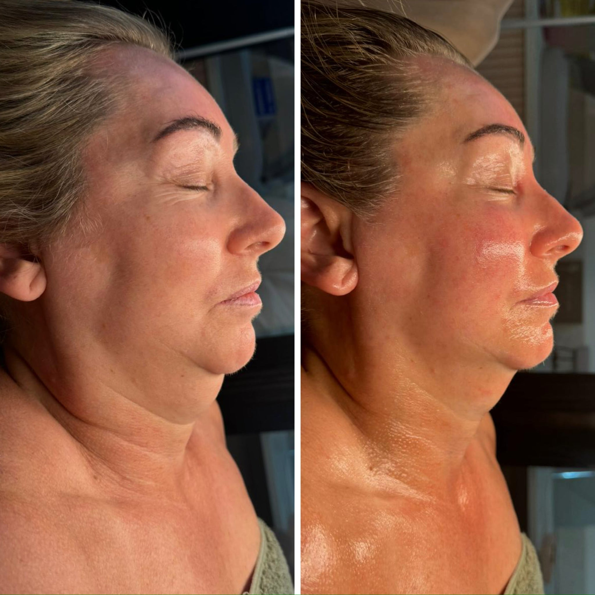 Luxury Lymphatic Lift facial