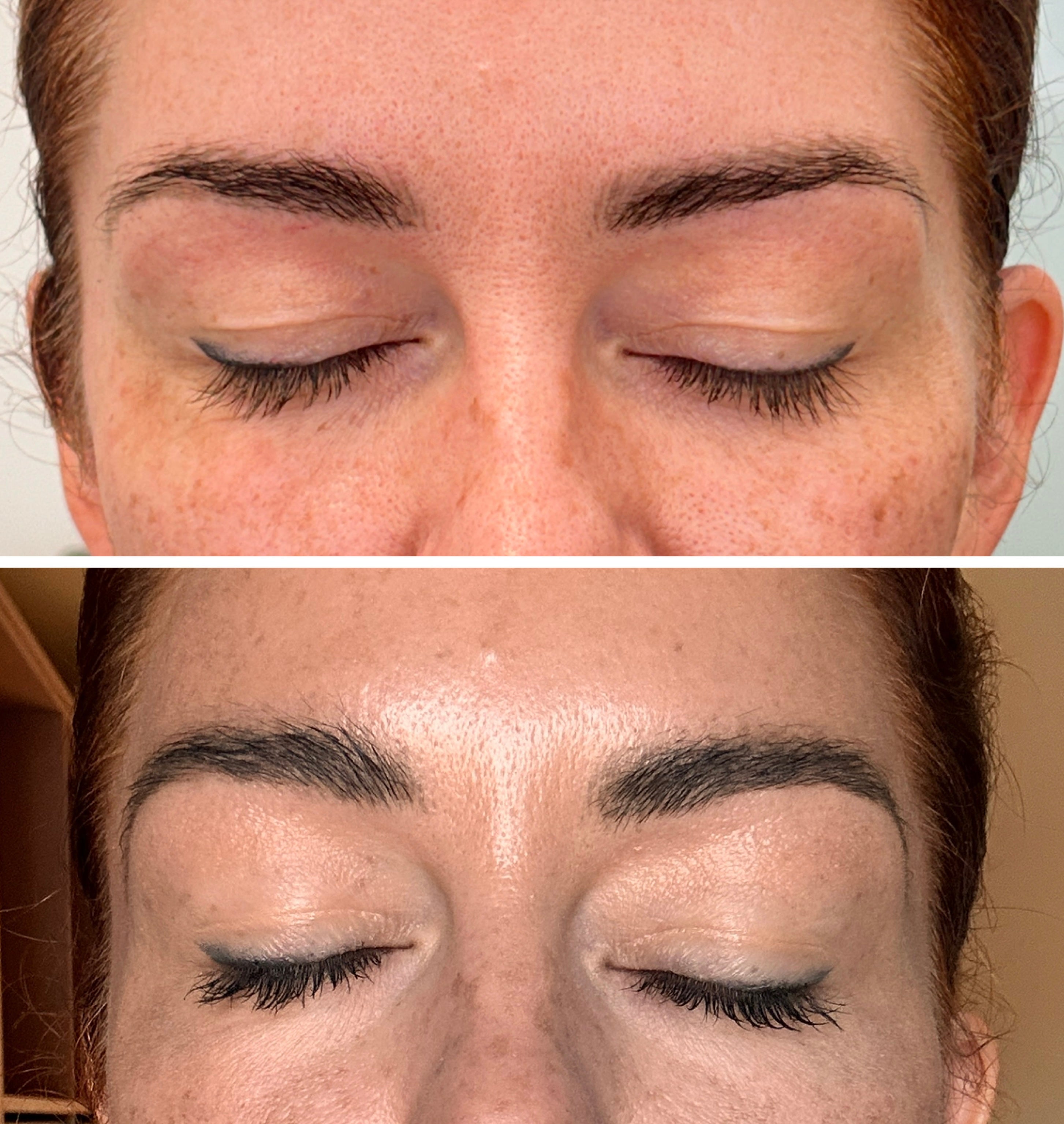 RF Microneedling Face Course