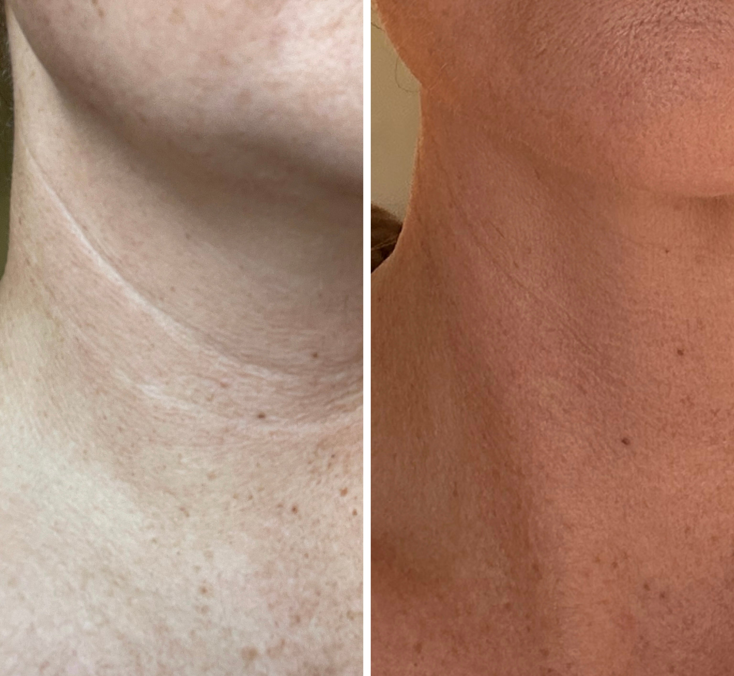 Radio Frequency Microneedling Face