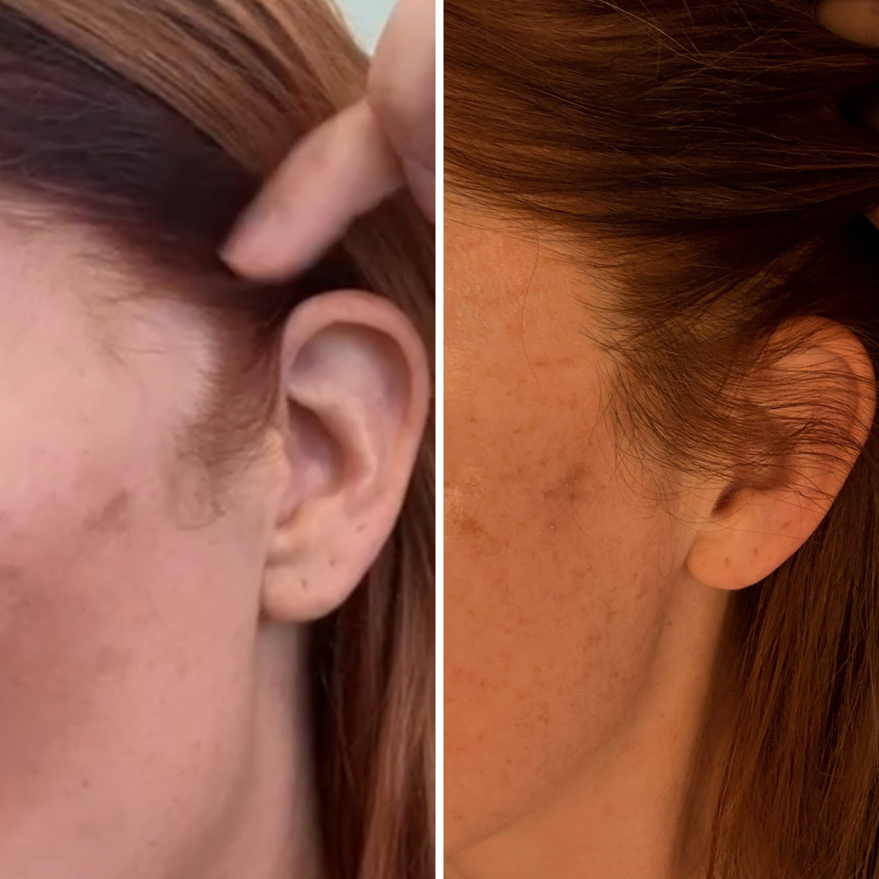 Exosome Hair Restoration with Microneedling & LED Therapy - Block of 6