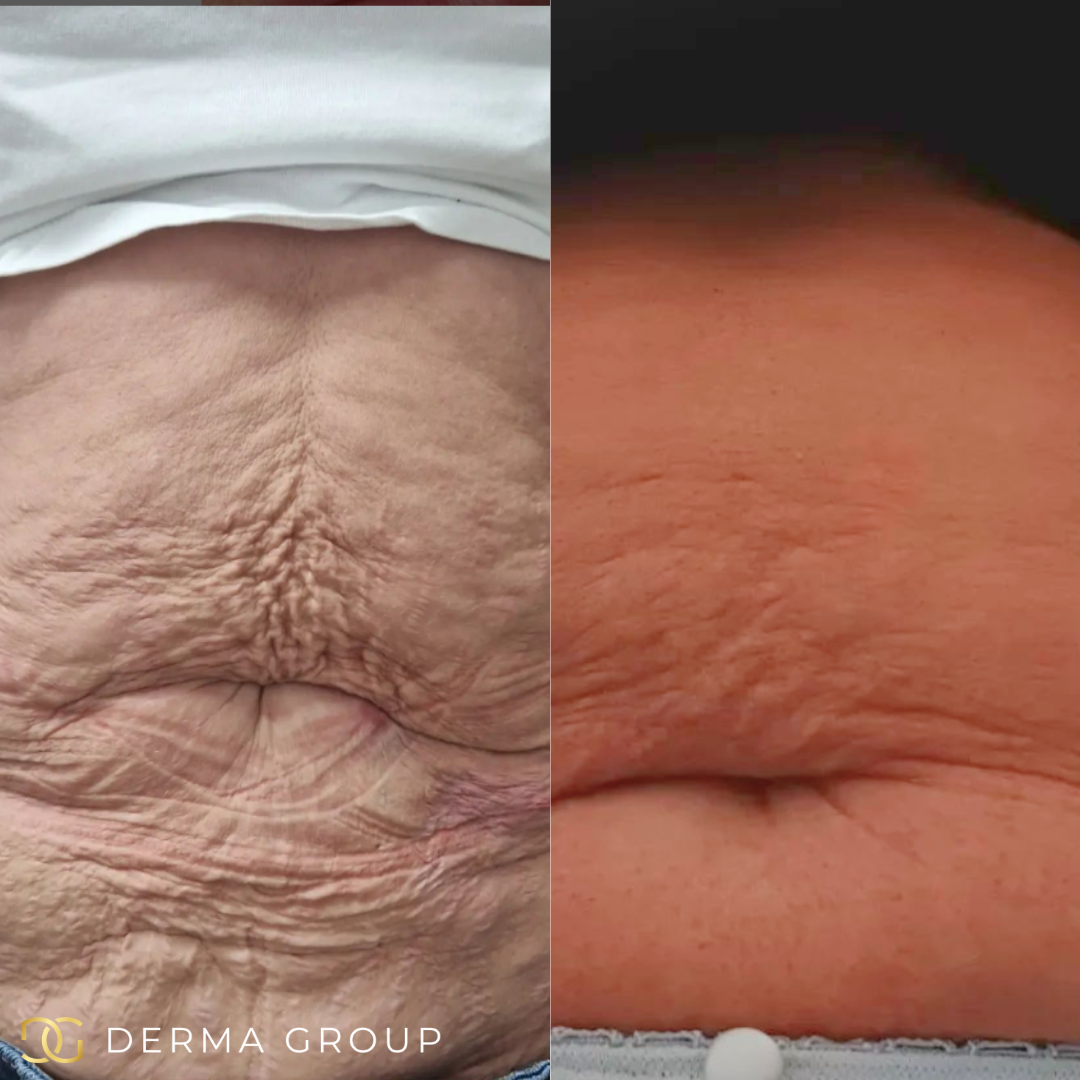 Radio Frequency Microneedling Body