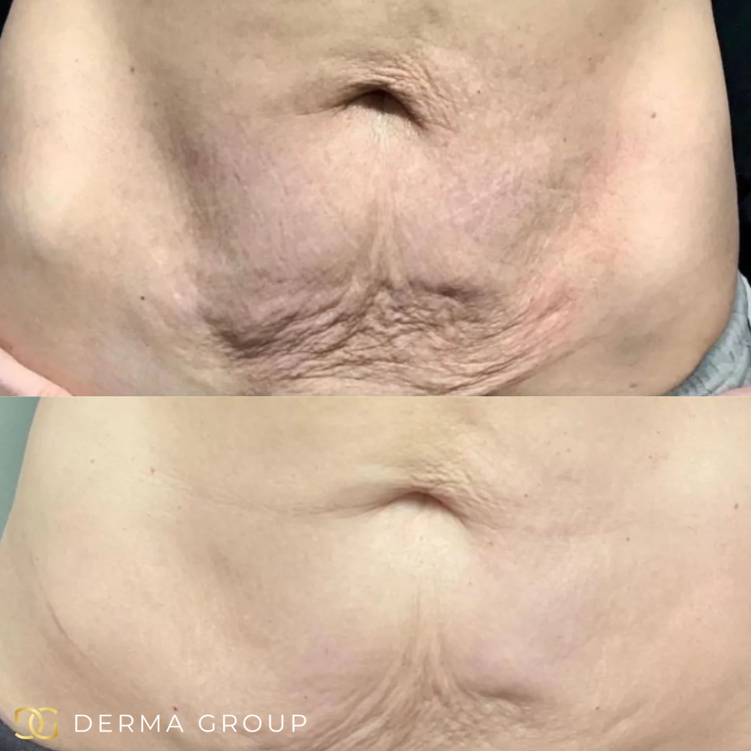 Radio Frequency Microneedling Body